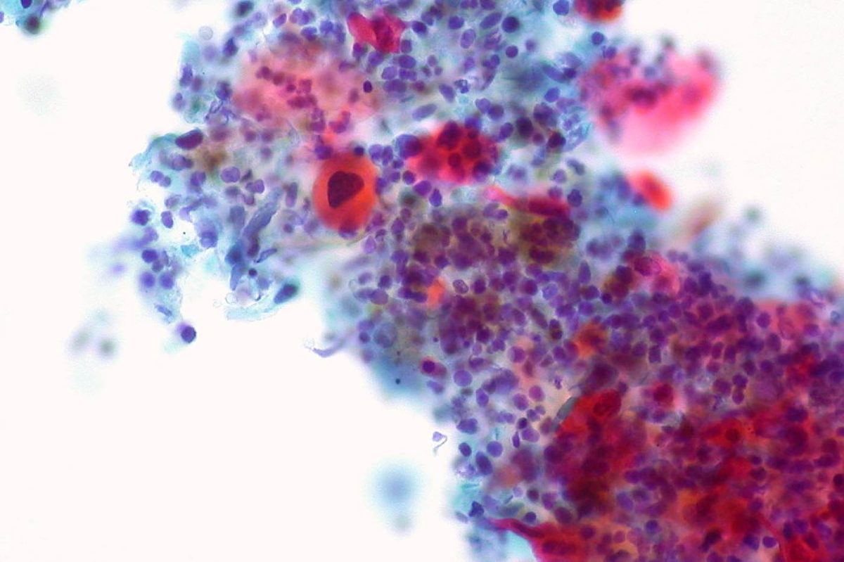 A squamous cell carcinoma tumor