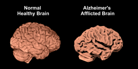 How Alzheimer's Affects The Brain