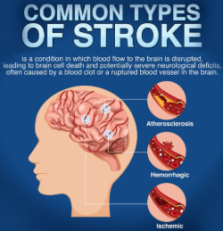 Strokes