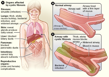 Cystic Fibrosis