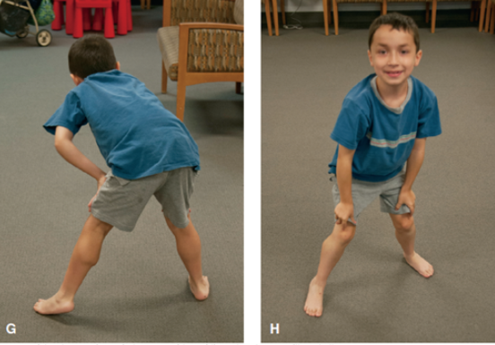 Duchenne Muscular Dystrophy