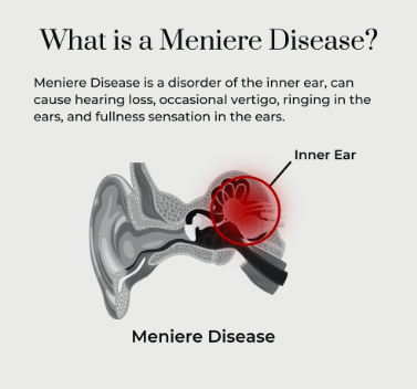 Meniere's Disease